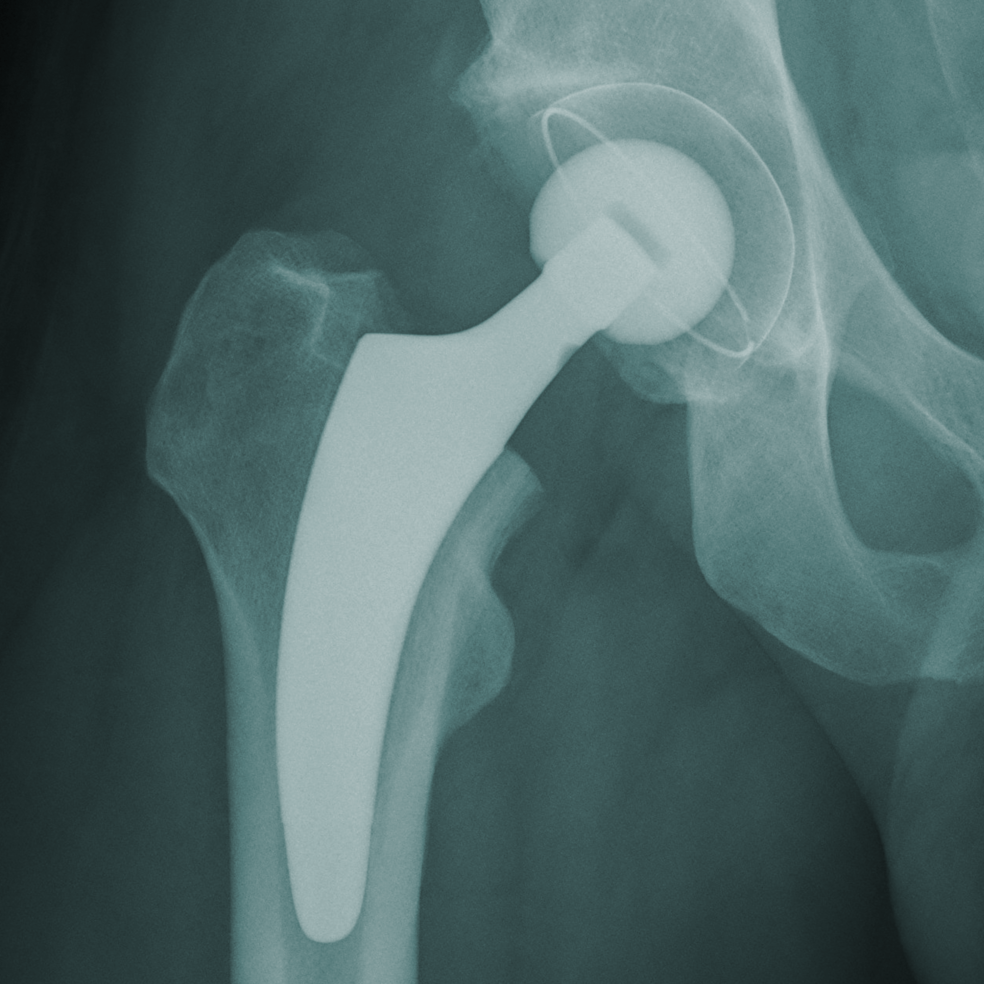 Das Bild zeigt ein Röntgenbild mit eingesetztem optimys Schaft und RM Pressfit vitamys Pfanne