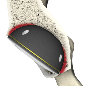 Das Bild zeigt eine RM Pressfit PE Pfanne im Knochen, Darstellung Stress shielding